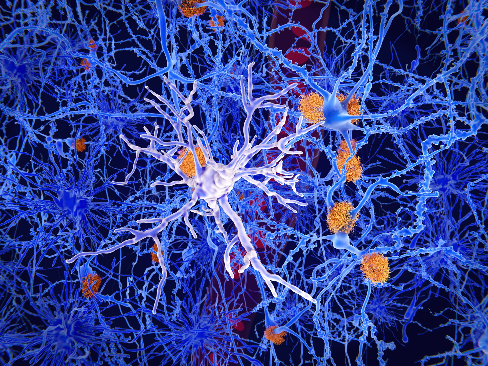 Stem cell transplants have shown promise in treating Alzheimer's disease in mice by replacing microglia, the brain's immune cells