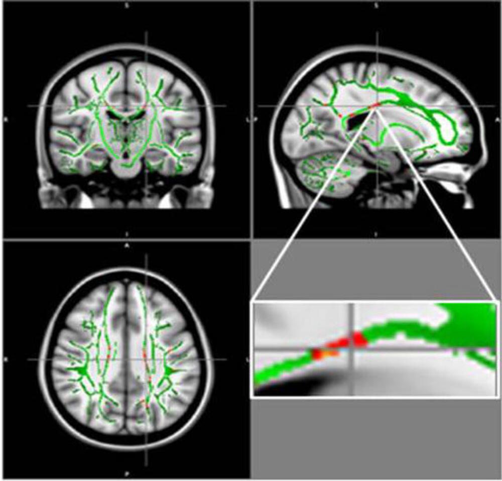 The FA skeleton, in green, is the average value in a healthy cohort, and the FA reductions are seen in red in the obese subjects