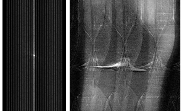 On the left is an example of a faster, under-sampled MRI set of data, and on the right is a complete image made from under-sampled data, highlighting the noise and artifacts in an incomplete MRI scan