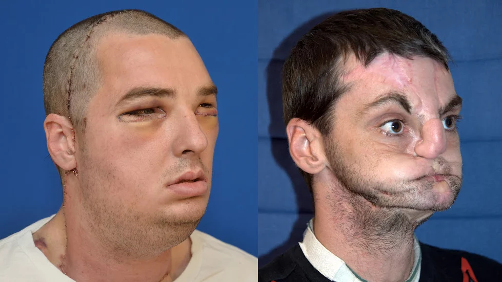 Remarkable transformation - before and after shots of the face transplant recipient (Photo: University of Maryland Medical Center)