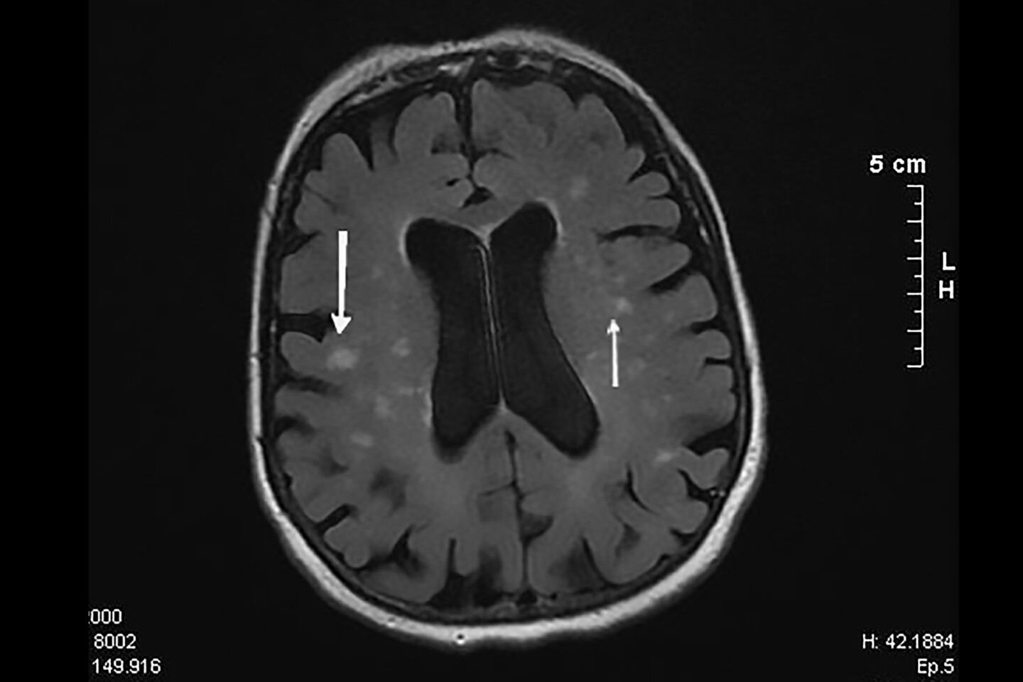 Oklar, MRI'da görülen beyaz cevher hiperintensitelerinin (WMH) olduğu alanları, beyin hasarının olduğu küçük alanları göstermektedir