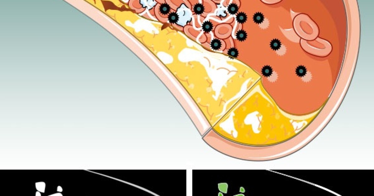 Blood clots made visible by nanoparticles