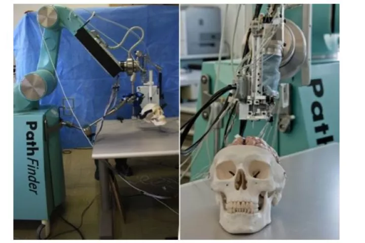 The ROBOCAST Project is developing a robotic system for assisting with keyhole neurosurgery