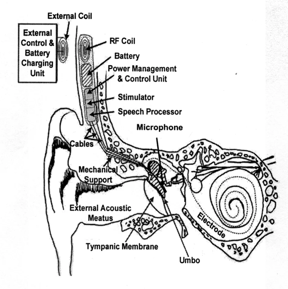 The proposed cochlear implant system (Photo: Case Western Reserve University, University of Utah)