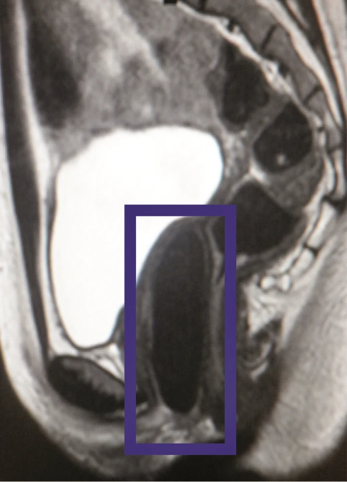 An MRI showing one of the lab-engineered vaginas in place