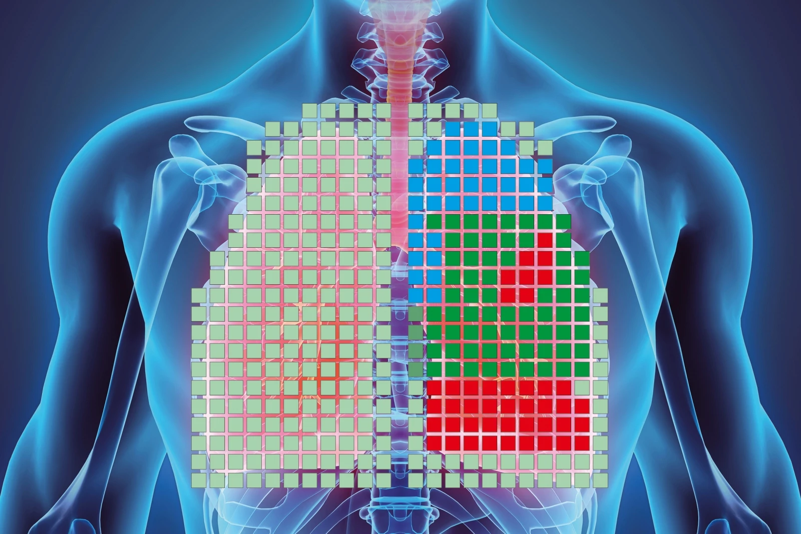 In this Pneumo.Vest image, red squares indicate areas of the lungs with poor ventilation