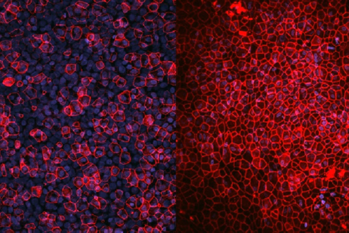 The lab-made lung under the microscope – on the left is the diseased lung; on the right the healthy lung
