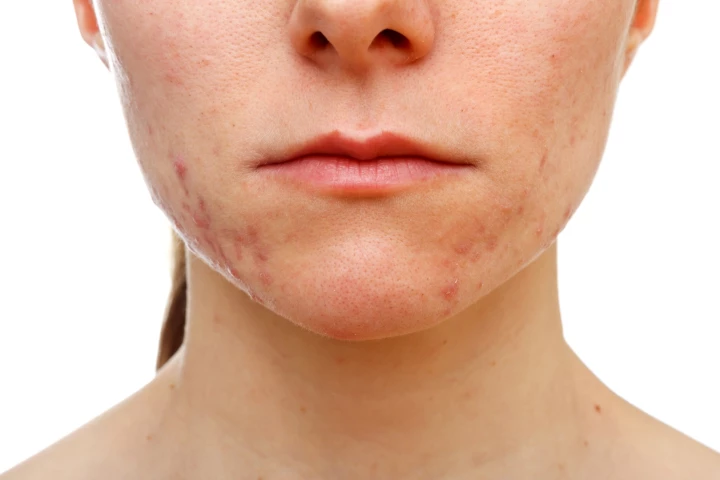 A new study suggests genes that influence acne also play a role in hair follicle formation