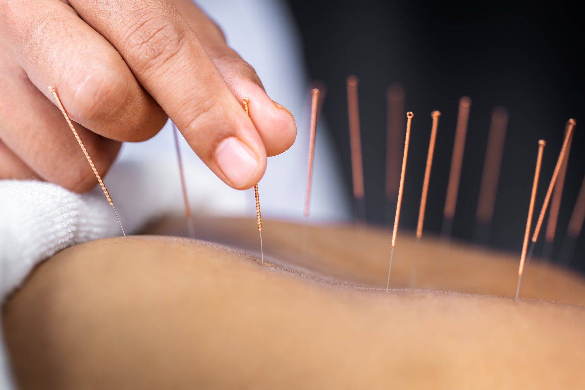 Fertility Acupuncture, London