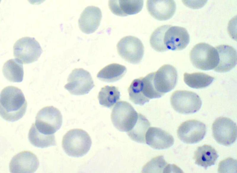 The dark blue spots are the malaria parasite, Plasmodium falciparum, attacking human blood cells under a microscope