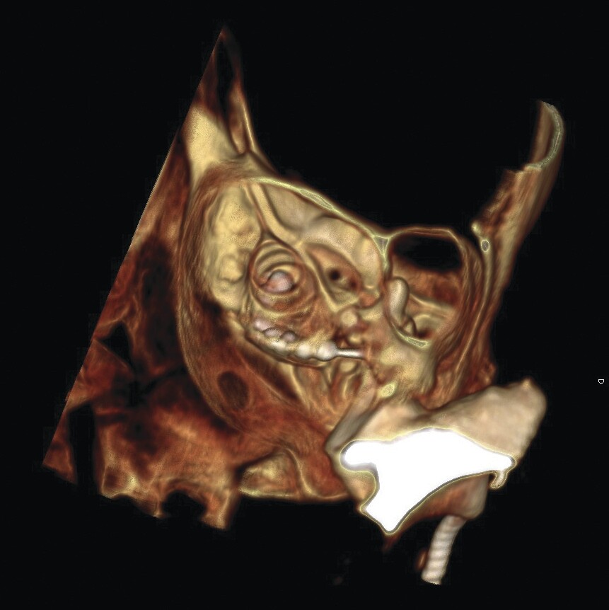 This hi-res CT image shows cochlear implant electrodes used for gene delivery (Image: UNSW)
