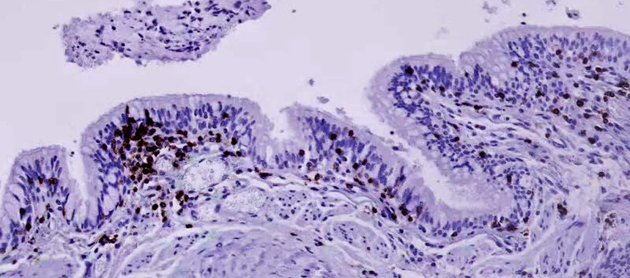 A biopsy of airway tissue from a patient with Chronic Obstructive Pulmonary Disorder, where the airways become inflamed and make it difficult to breathe