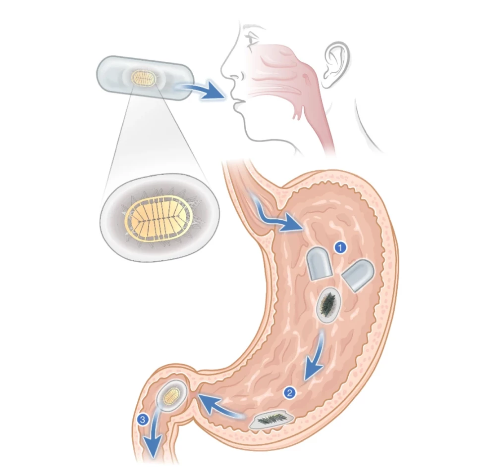 An illustration depicting how the MUSAS would be delivered into the body inside a capsule