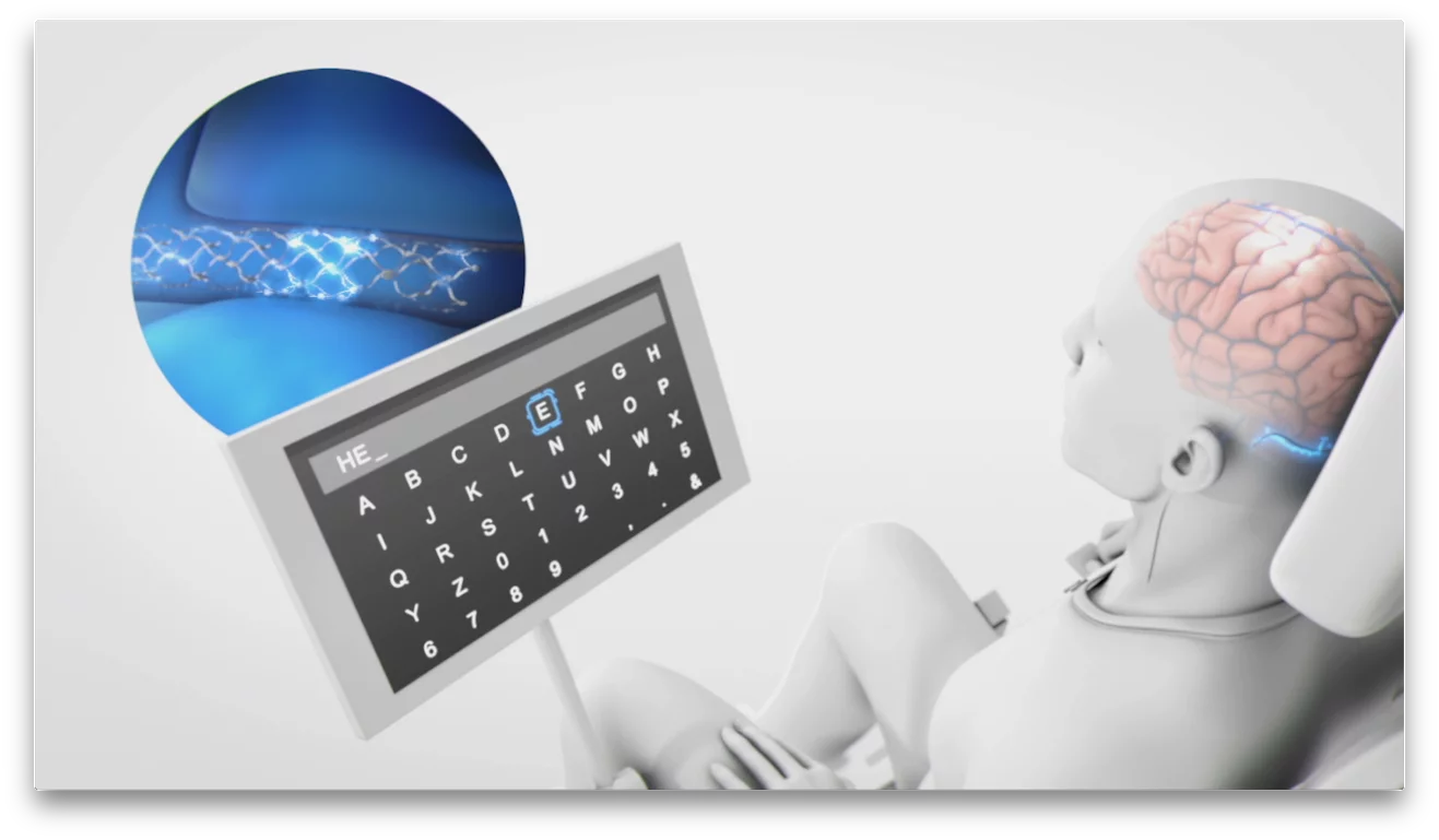 The scientists behind Stentrode have high hopes for its applications in treating sufferers of paralysis