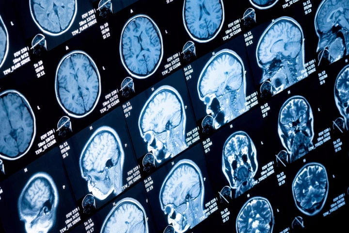 Scientists at Newcastle University discovered that a common form of fatal brain tumor feeds off of its fats by slowing its growth in mice with a drug that slows the production of fatty acids.