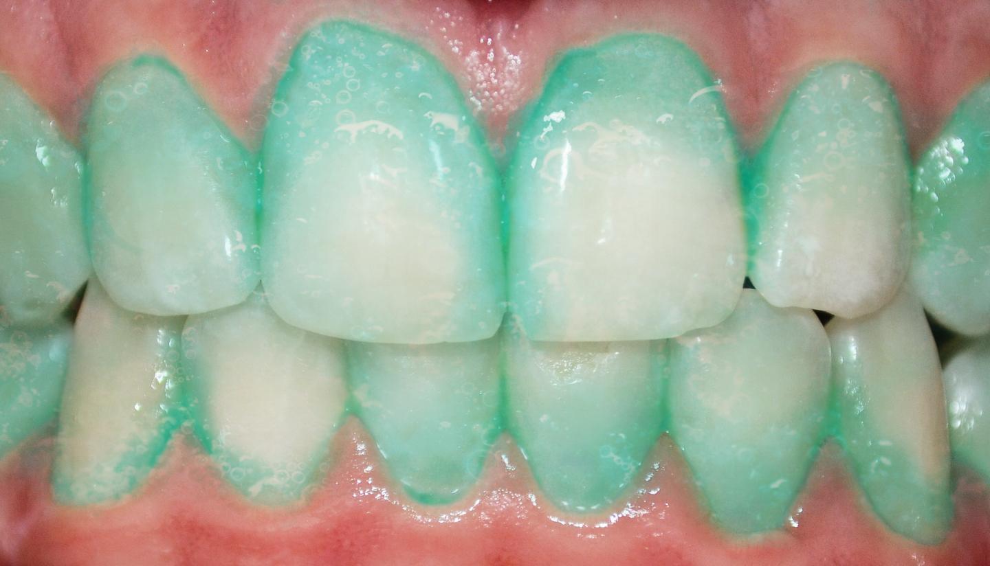 Cleaner teeth linked to lower systemic inflammation in toothpaste study
