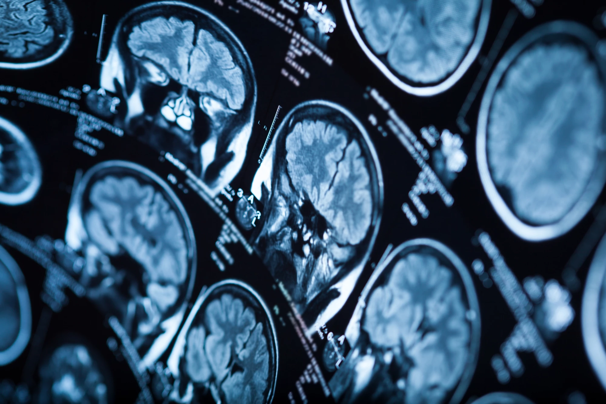 "Brain changes found in obese adolescents related to important regions responsible for control of appetite, emotions and cognitive functions," says Pamela Bertolazzi, co-author on the new study