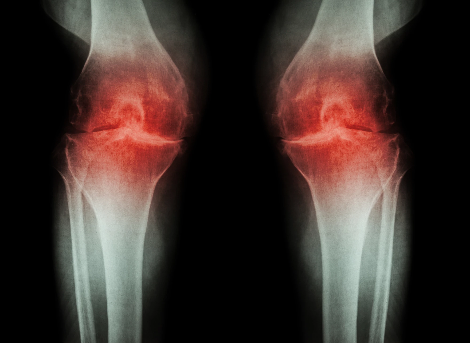Researchers have investigated the role a particular signaling pathway plays in osteoarthritis pain