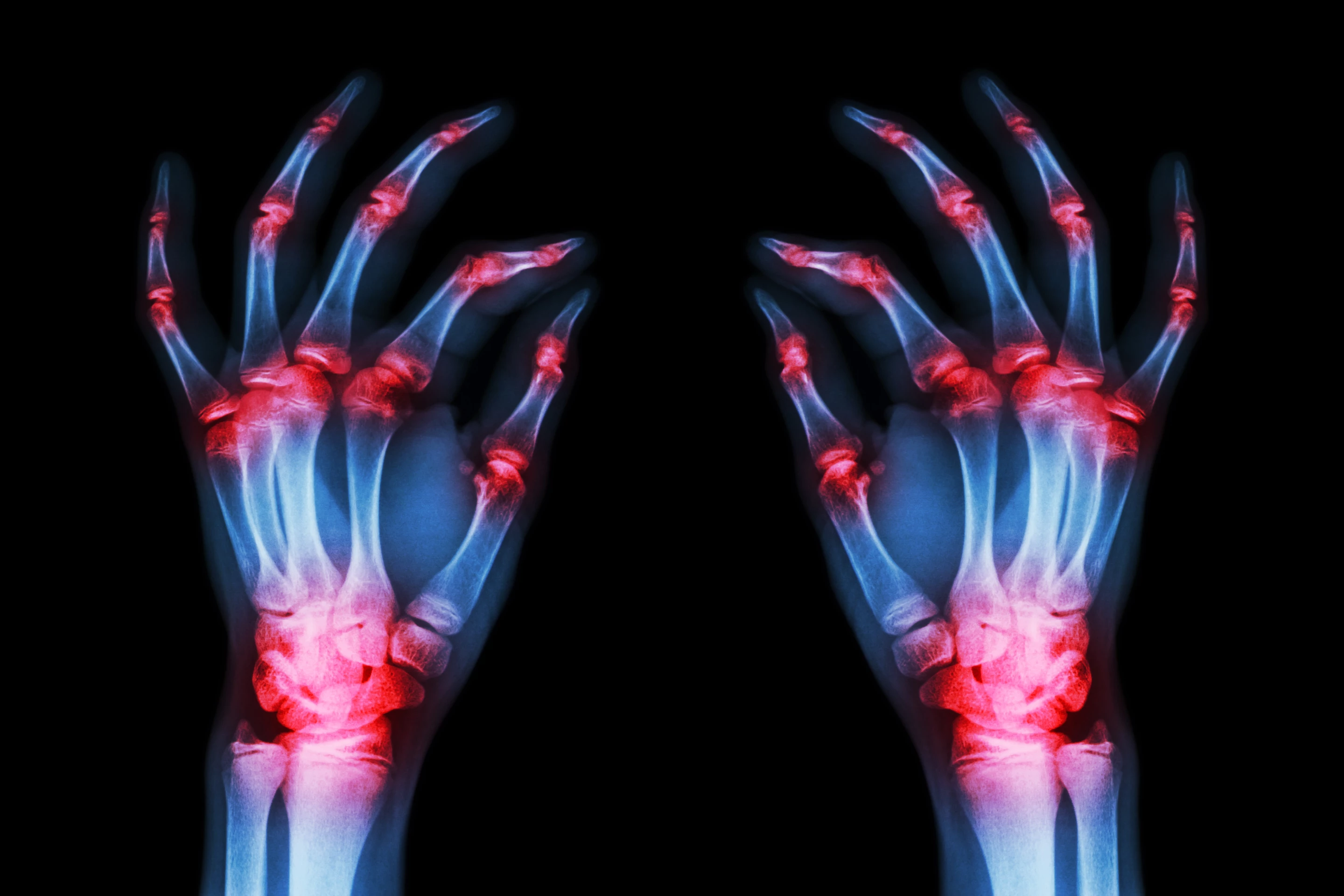 The research is still in preliminary stages but if further validated it could lead to new classes of drugs to treat rheumatoid arthritis
