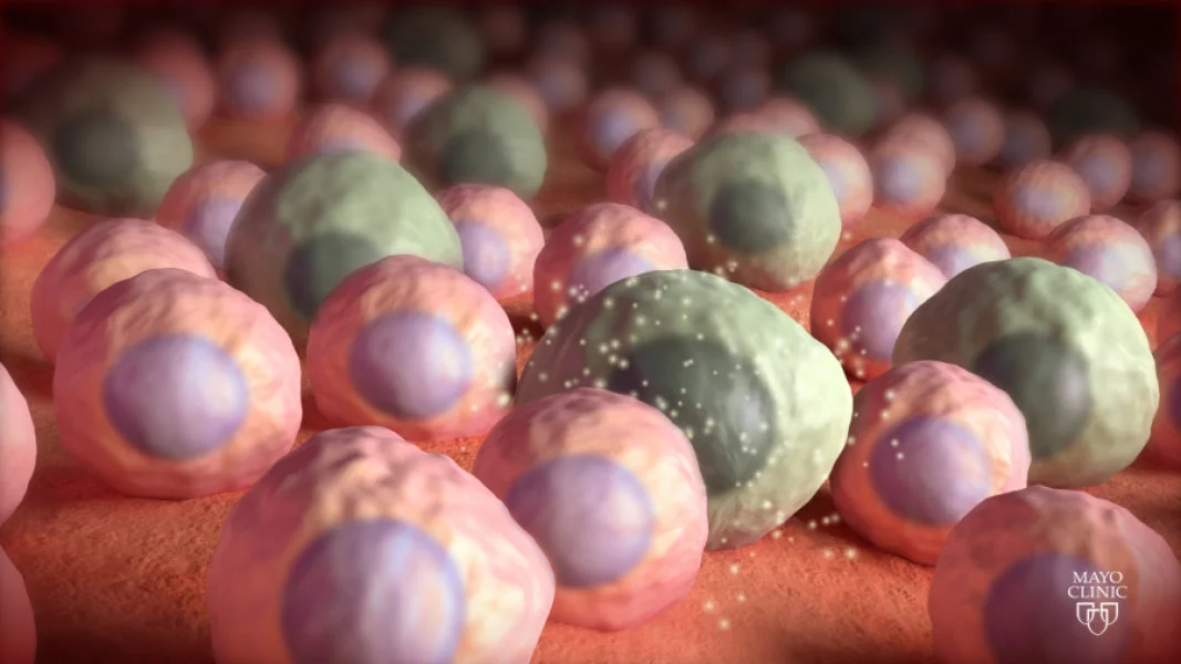 Zombie cells, aka senescent cells, have been found to accumulate in the brain ahead of the toxic protein build-ups that are generally implicated in Alzheimer's disease and dementia