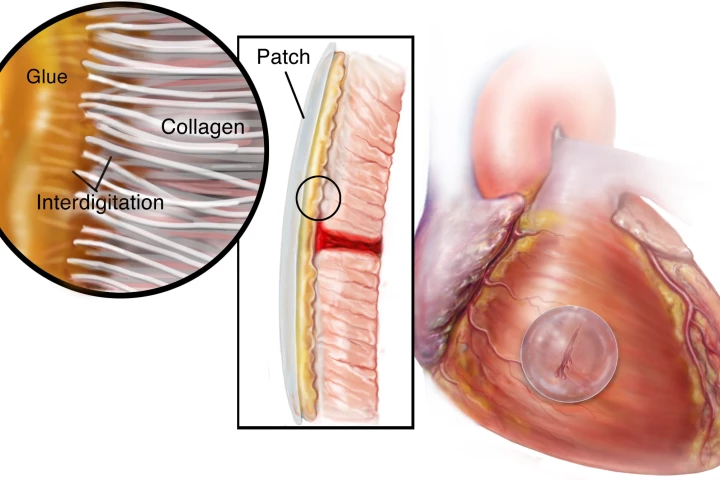 HLAA sets to an elastic consistency, and bonds with cardiac tissue
