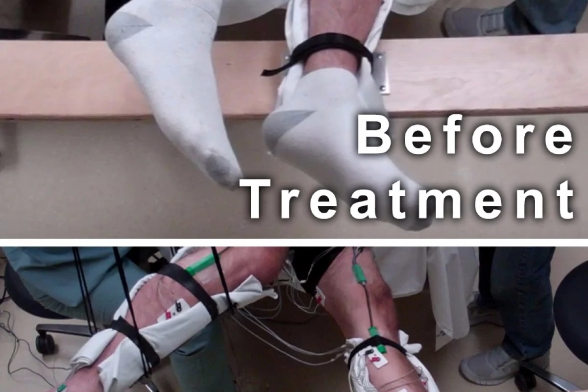 Five paralyzed men treated with a non-invasive form of spinal stimulation gained significant voluntary movement of their legs