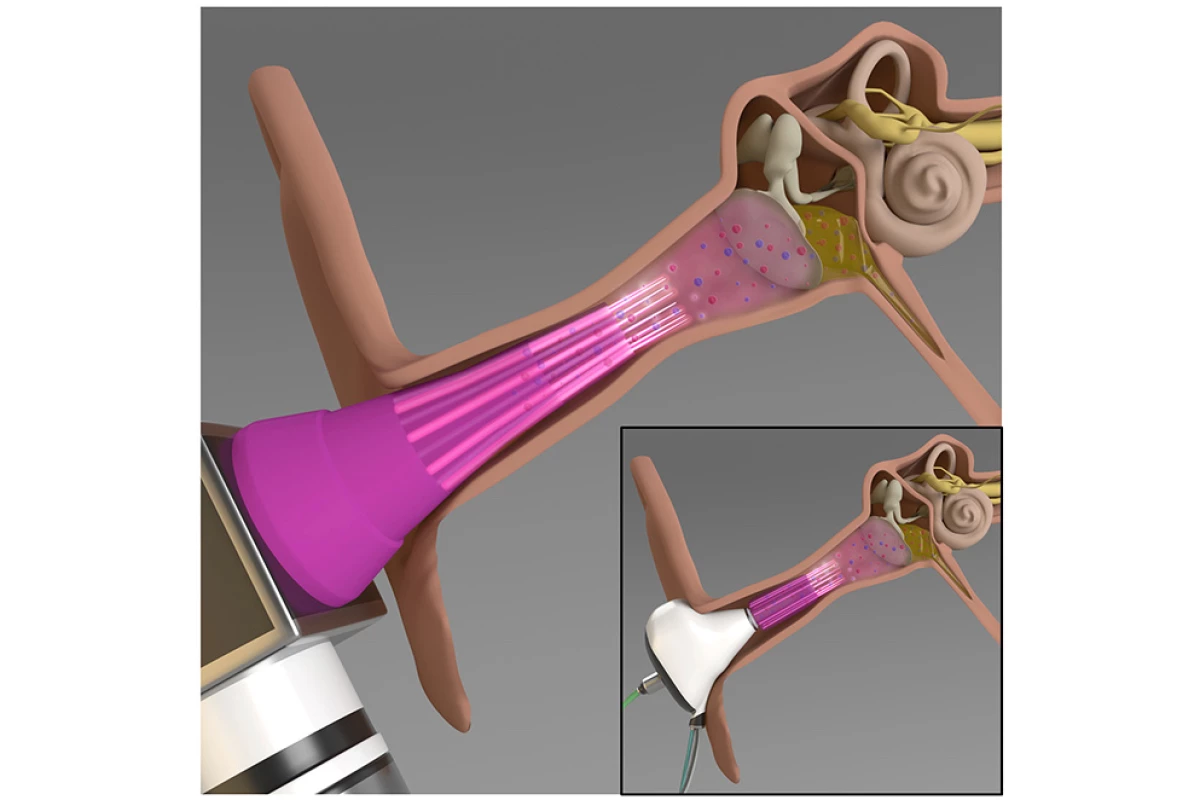 A diagram showing the device (lower left, with purple earpiece) inserted into the ear canal – the inset shows a proposed earbud-like version of the technology