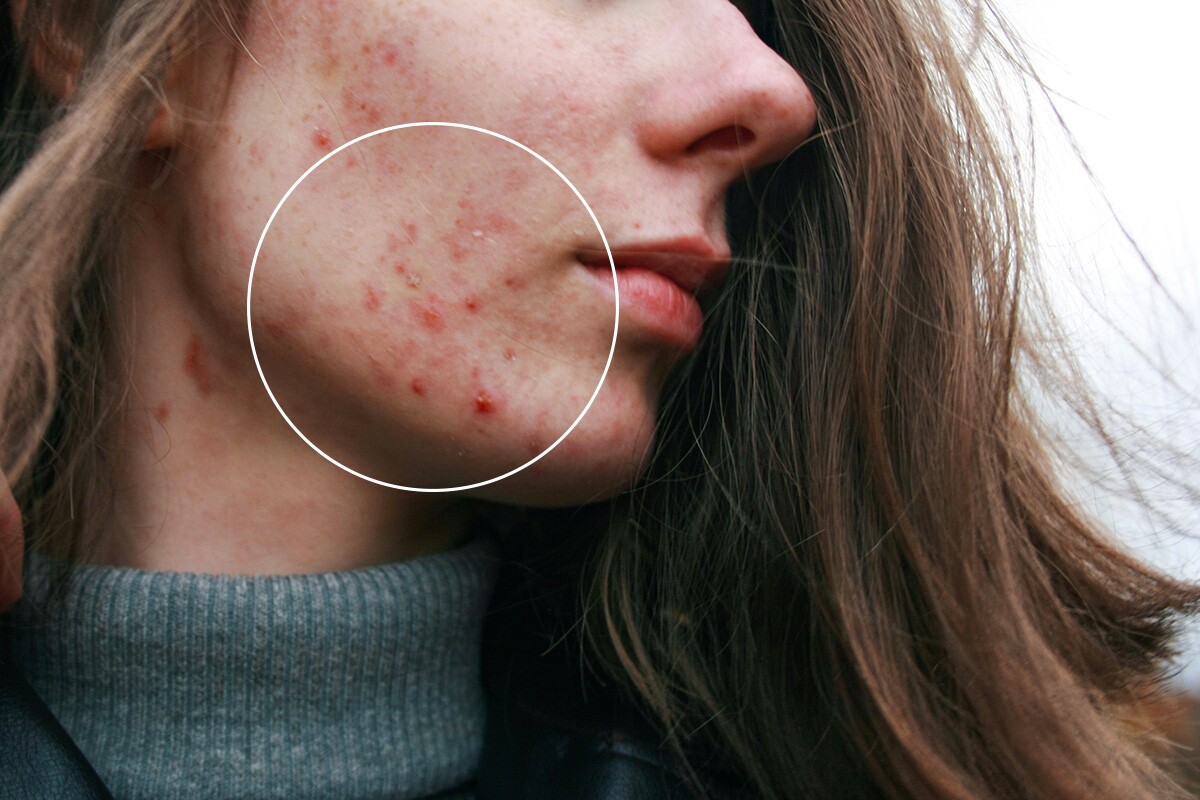 Microneedle patch uses bubbles to fight stubborn acne