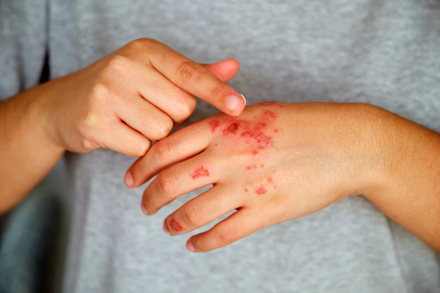 For some people with eczema, traditional creams and ointments aren't effective