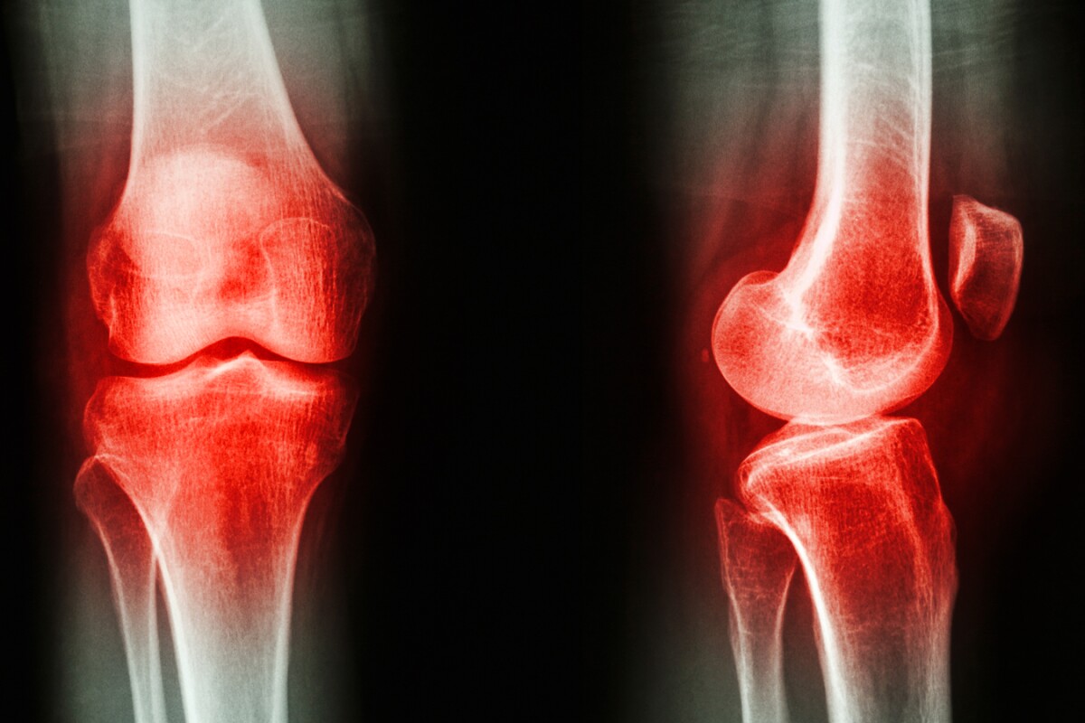 Biomarker discovery points to blood test for osteoarthritis