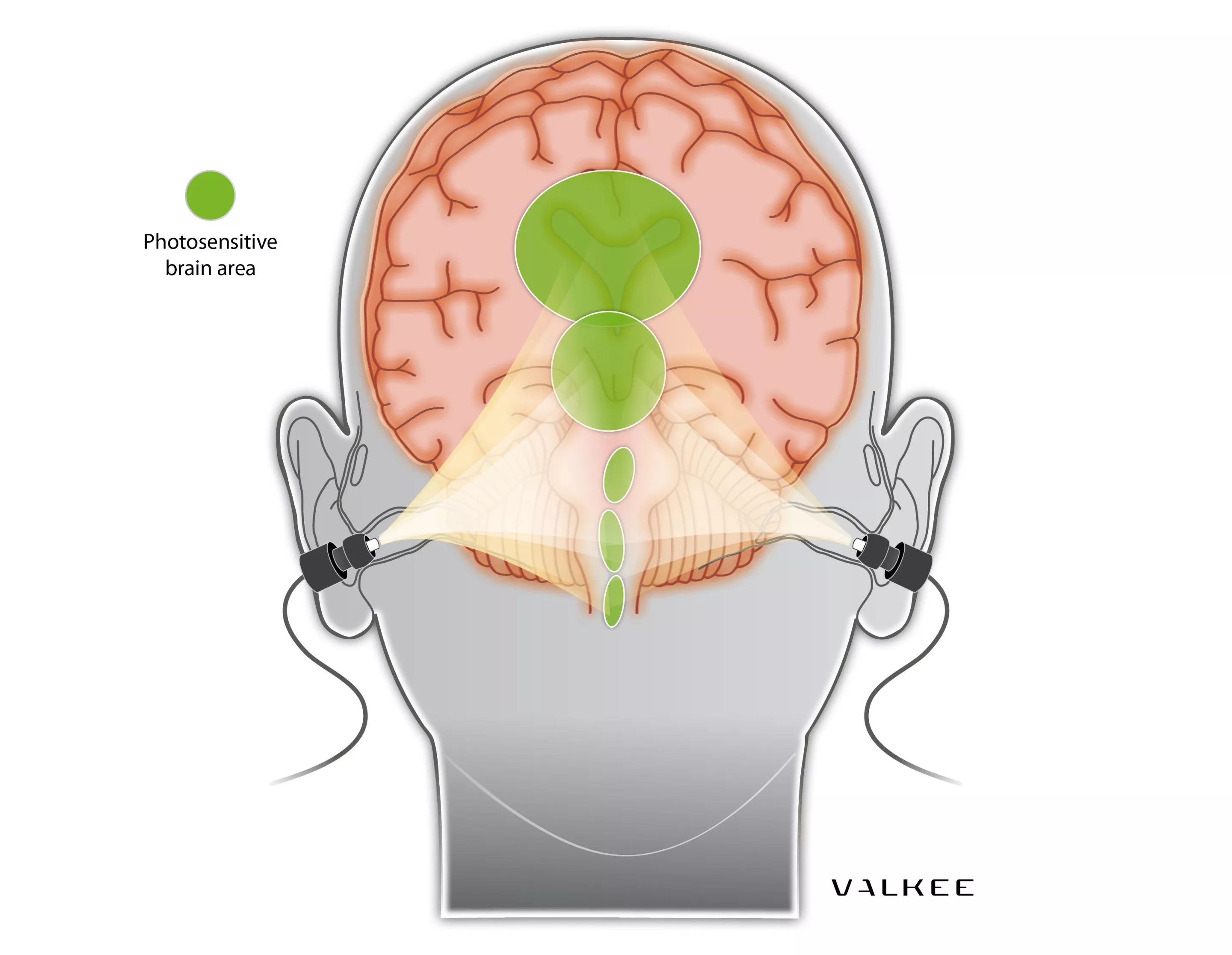 A diagram illustrating how the Valkee is supposed to treat SAD