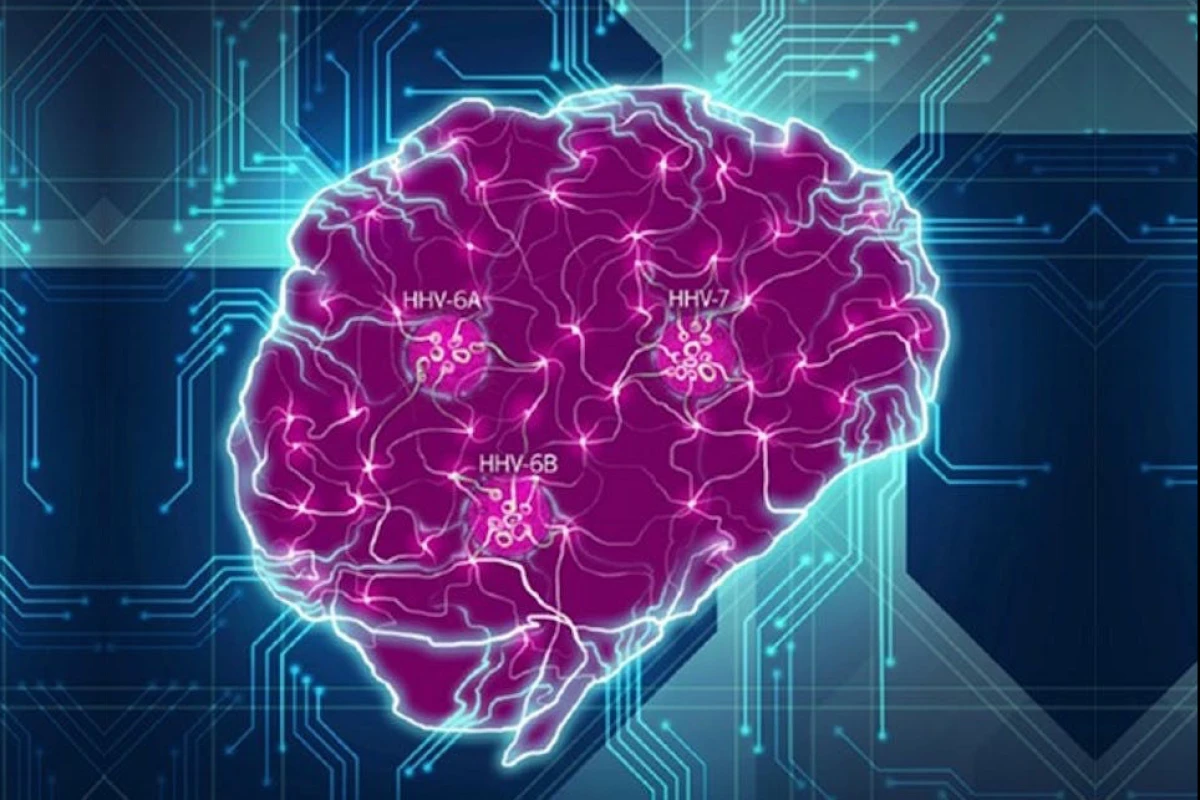 A new study has resurrected an old hypothesis suggesting the herpes simplex virus may play a major role in the onset of Alzheimer's disease