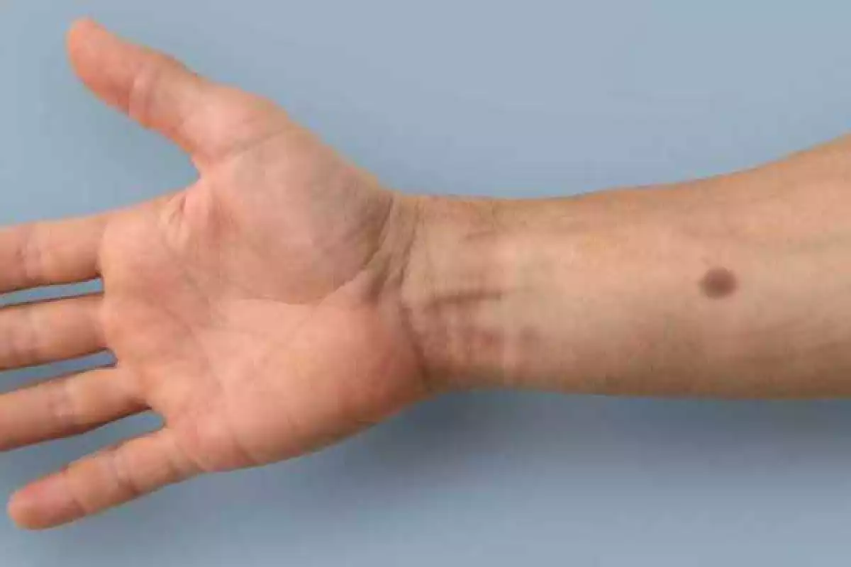 Researchers at ETH Zurich have developed an early warning system for cancer that grows an artificial mole on your skin when it detects certain biomarkers