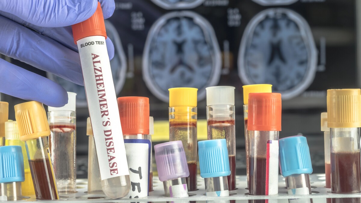 FDA approves first blood test for early Alzheimer's detection