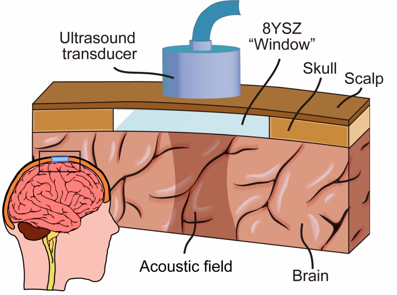 A diagram illustrating where the implant would go