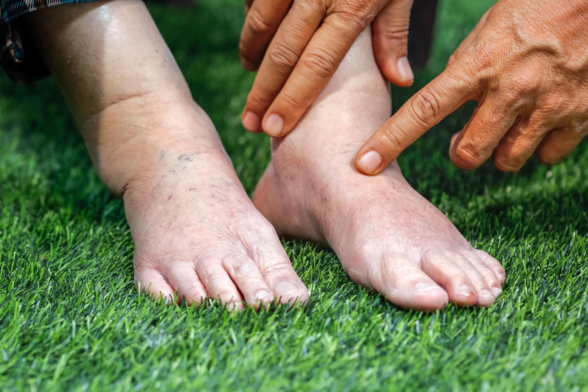 One sign of heart failure is fluid collection (edema) in the lower extremities