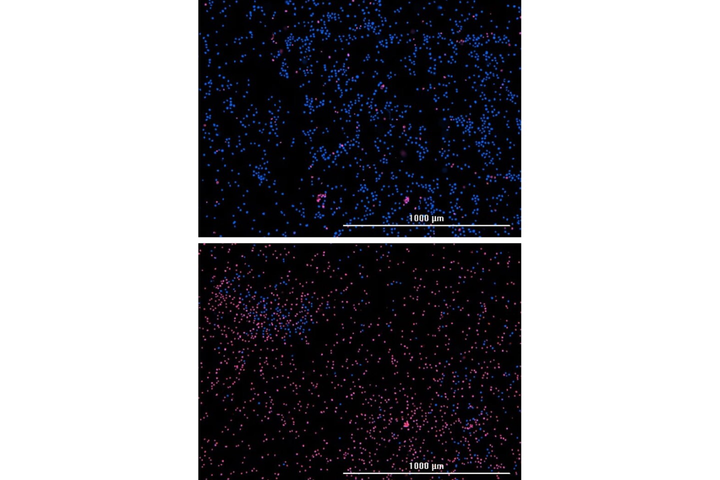 Microscope images of acute myeloid leukemia cells, taken before (top) and after treatment. Blue dots indicate cancer cells, while red ones indicate dead cells