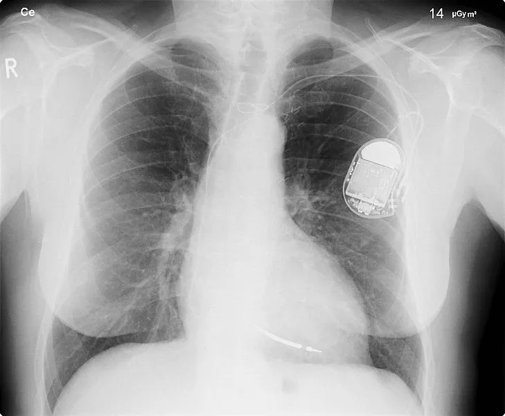 Regular implantable defibrillators (like this one) may save patients' lives, but also inflict a lot of pain and trauma (Photo: Wikimedia Commons)