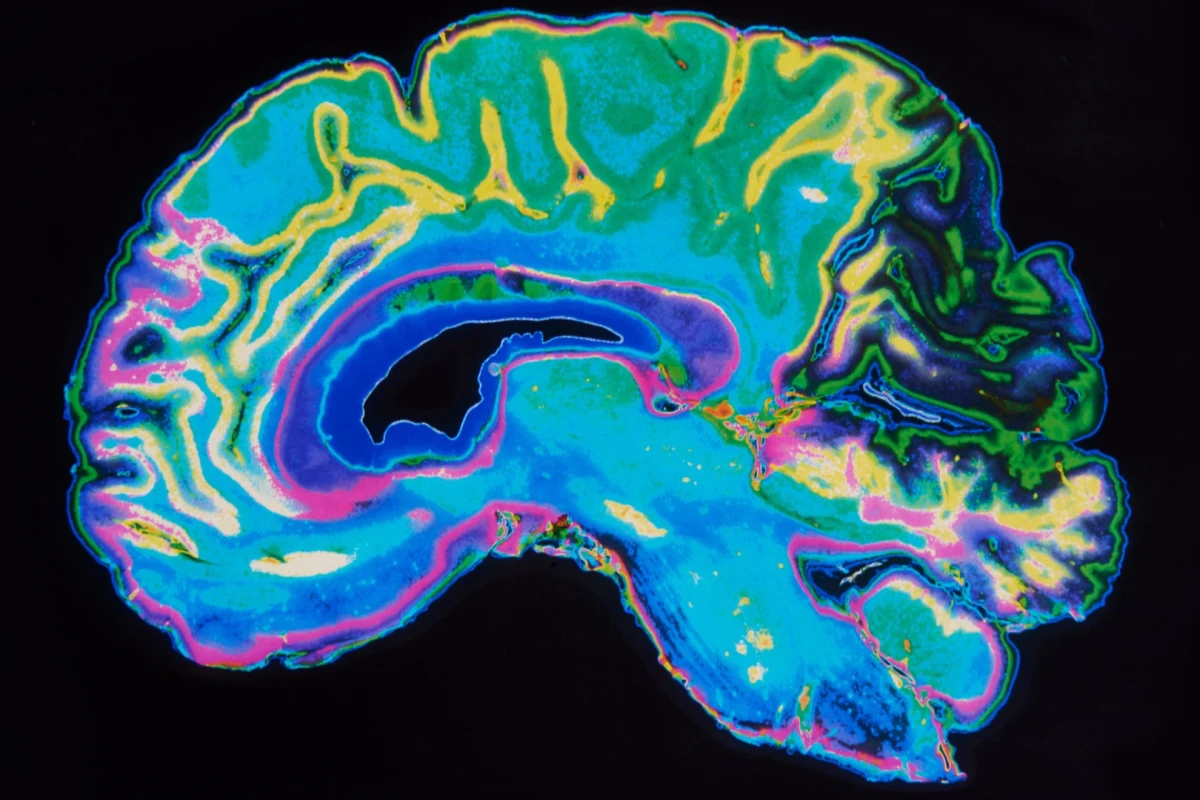 A new study suggests a simple brain scan could identify whether a person is having suicidal thoughts