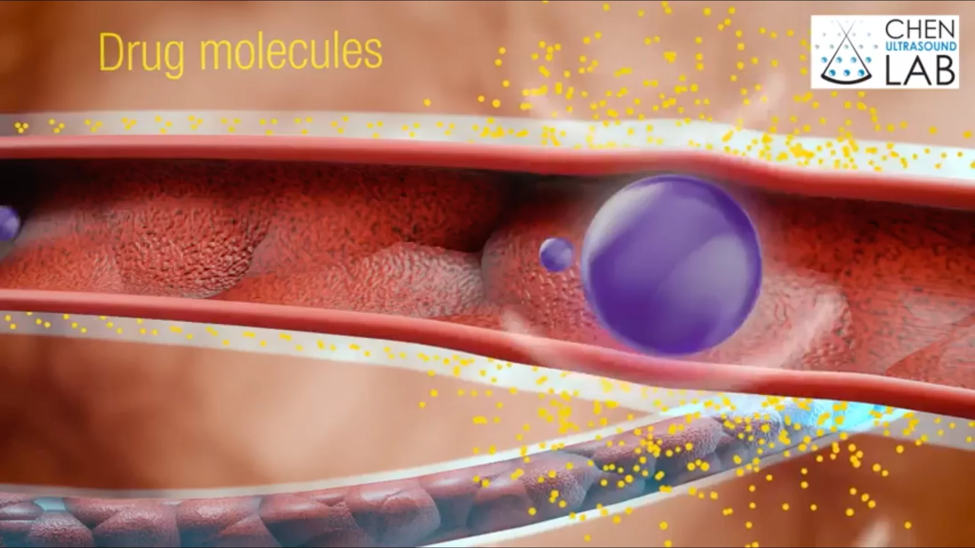 Drug nanoparticles could be delivered directly to the brain through a nasal spray, which is then further targeted to the right area by ultrasound waves