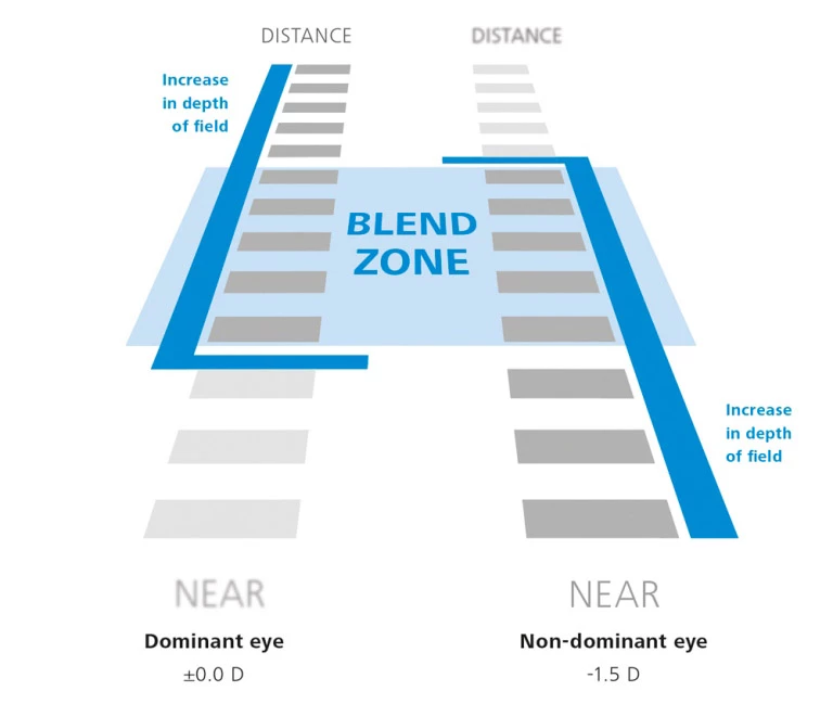 The Presbyond process creates two different focal lengths, giving you a reading eye and a distance eye – but rather than perfectly correcting for these two distances, changes are made to create a "blend zone" in the intermediate distance