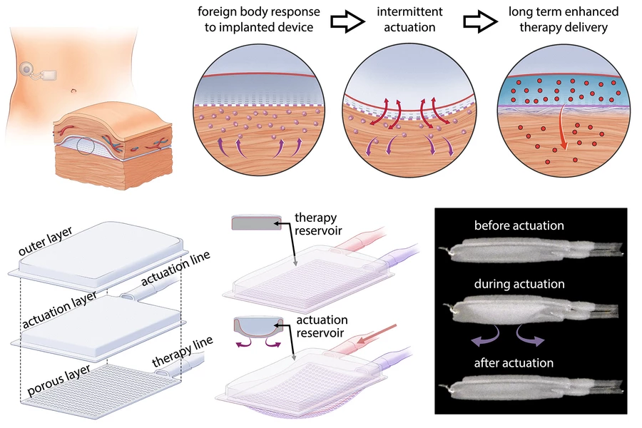 A diagram illustrating how the inflatable implant works to reduce scar tissue formation
