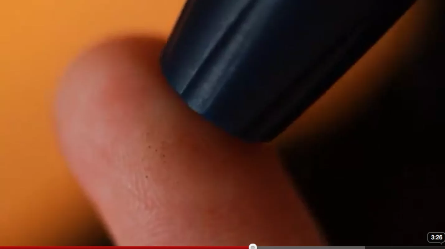 Type 1 diabetics need to monitor their blood sugar levels several times a day with this painful procedure