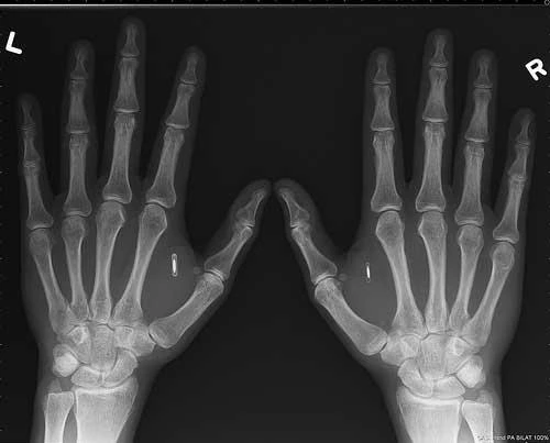 An x-ray of Amal's hands