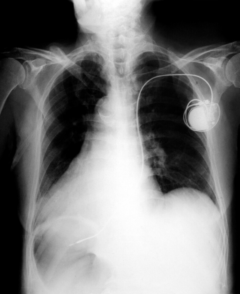 Cardiopowered pacemakers human heart more than up to the challenge