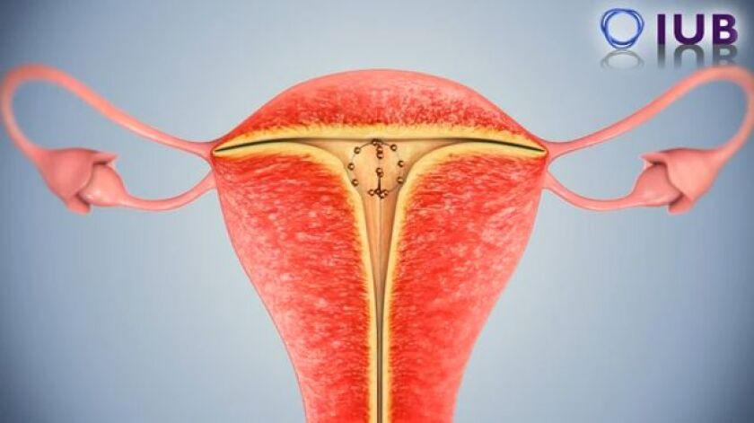 The Intra Uterine Ball, as it sits within the uterus
