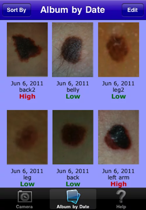 Uploaded photos can be stored on MelApp and saved according to date, label or risk so you can track changes over time