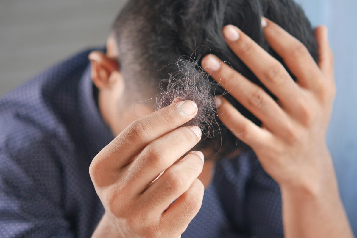 Natural sweetener found to turbocharge baldness treatment