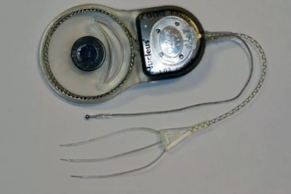 The vertigo-alleviating cochlear implant