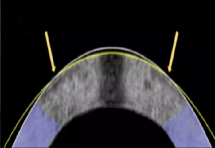 The electromechanical reshaping technique successfully flattened this rabbit cornea, shown in a cross section, from its original shape (white line) to a corrected one (yellow line)